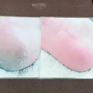 足の角質除去
