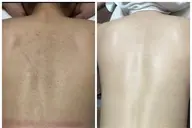 レディース全身脱毛すごくお得!!