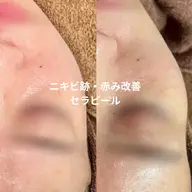 セラピール＋高濃度パック｜赤み・ニキビ跡・ざらつき集中ケア