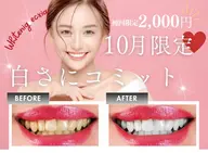 【10月限定🌟エリア最安値!!】強力セルフホワイトニング30分初回体験 ¥7980→¥2000