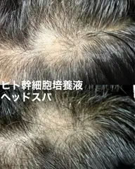 【頭皮/白髪・薄毛育毛コース】ヒト幹細胞活性スパ頭皮診断+頭皮クレンジング・保湿+ヘッドマサッージ(120分)