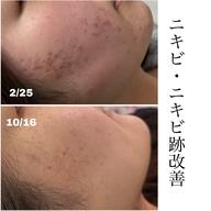 【ニキビ・ニキビ跡さん必見‼️】 本気の肌質改善エステ🤍