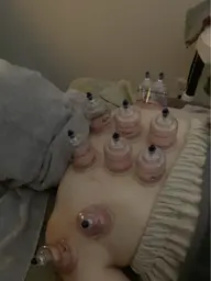 カッピング(1箇所)