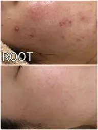 【ミニモ学割】ニキビ・イチゴ鼻改善デトックスフェイシャル💆♀️💆【Minimoモニター・口コミプラン】