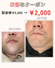 メンズヒゲ全体脱毛¥6,600→¥2,000