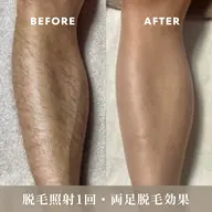全身脱毛(顔・VIO込み)(シェービングあり)