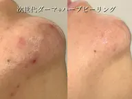 【全ての肌悩みに◎最強肌質改善】オーダーメイドハーブピーリング【剥離なし】+次世代プラズマ通常12,000→