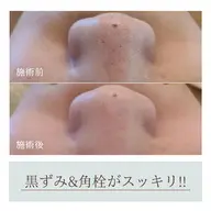 小顔&毛穴撃退!!陶器のようなお肌へ カーボキシープレミアムコース