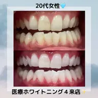 歯科提携ホワイトニング都度払い45分照射（15分×3照射）🦷🩵
