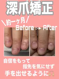深爪矯正【長さ出し】◆カラーなし◆(オフ込)むしったり割れたり噛んで小さくなってしまった爪も美しく綺麗な状態に✧︎
