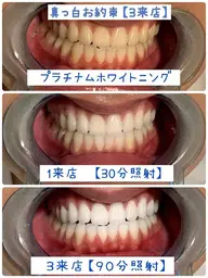セラミックの様な🦷歯になりたい方はこちら❣✨プラチナムホワイトニングコース✨9照射３来店【🦷本数無制限🦷】