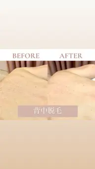 【自己処理しにくいところも一気に解決!】☀️ドレスライン(背中•うなじ)脱毛☀️