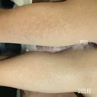 【8月限定！撮影モデル】二の腕ハーブピーリング🌿