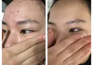 人気No.2✨ハーブピーリング剥離なし(全顔)12000円→3300円