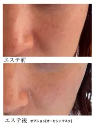 ミニモ限定！今だけ！【小顔へ、リンパを流す】フェイシャルエステ/エイジングケア＋無料鼻パック