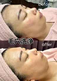 “毛穴どこいった?!”と驚かれる透明肌へ💫毛穴集中洗浄フェイシャル【平日限定】