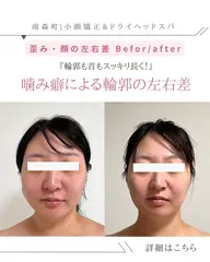 🌿 30代限定 3ヶ月間(6回来店条件)90分【エラ張り/食いしばり解消小顔ヘッドスパ】