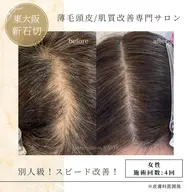 【プロセル育毛促進トリートメント✨️】圧倒的驚異のスピード改善‼️薄毛、抜け毛、ボリュームダウン、産後など！後戻りなし！