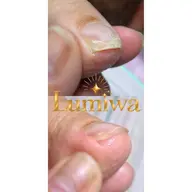 あとお一人です☆【練習モデル】巻き爪補正|親指1本