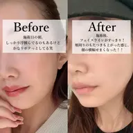 【30代​〜​50代の方限定】リフィット×小顔ラジオ波ダブル施術×プラズマゴールドでほうれい線・たるみにトリプルアプローチ！