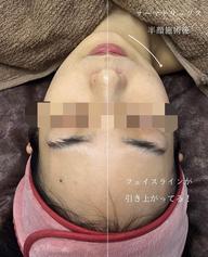 【全体的にスッキリさせたい方】高周波引き締めケア(顔+顎下+首)+水光パック
