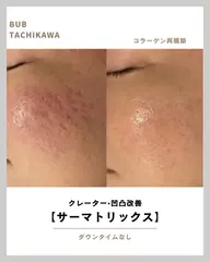 【ニキビ跡・クレーターに特化】サーマトリックス頬集中照射+鎮静パック|凸凹肌を均一に整える