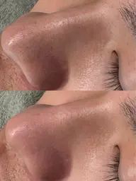 フルフェイス毛穴洗浄+贅沢ジェルパック🫧