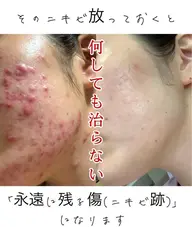 【本気で改善したい方必見👀剥離あり】全顔ハーブピーリング🌿27,500円→7,980円 ※メッセージにてご予約確定