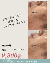 剥離しない[ハーブピーリング] 炎症を抑え、肌トラブルを根本ケア