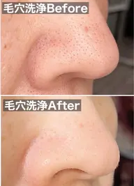 【モデル募集】 毛穴洗浄🫧40分 🌟3980円🌟 (口コミ、写真掲載にご協力いただける方)