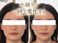 🌸美容整体コース|小顔矯正×バストアップ(セット)
