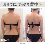 【背中・二の腕集中】夏までに、すっきり背中✨(残り2名様|30分施術プレゼント🎁)短期集中痩身60分×6回