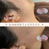 もみあげワックス脱毛🪿横顔美人に🪽ダブル脱毛変更＋1500円