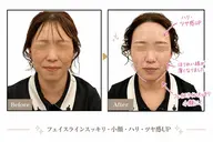 【小顔・たるみケア】✨極上リフトＵＰ✨美顔器フェイシャルエステ