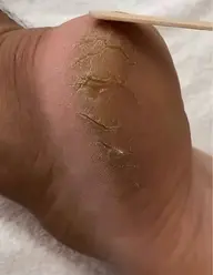 動画モデル募集先着5名⭐️フットケア&足裏の角質ケア【定員になりましたので条件厳しくしております】