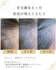 【育毛鍼】で薄毛・抜け毛・産後脱毛を改善♪