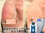 【汗&紫外線ダメージリセット❣️】水玉リフティング&白玉肌管理