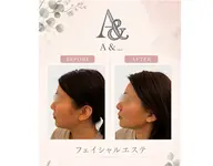 フェイシャル整顔エステ(特別3回セット)7月末まで!!!