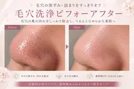 毛穴洗浄(鎮静パック付き)
