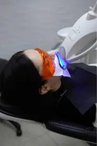 セルフホワイトニング体験モニター