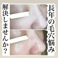 毛穴エクストラクションで長年の悩みを解消しませんか?