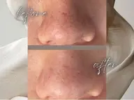 毛穴洗浄体験💆🏻♀️💦