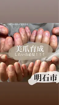深爪矯正 40分