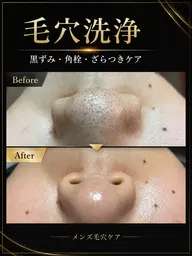 【毛穴洗浄】メンズ毛穴洗浄体験 ¥980|黒ずみ・角栓