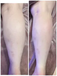 【痩身】ふくらはぎ 浮腫もスッキリ♪キャビテーション→ラジオ派→吸引EMS 施術時間30分