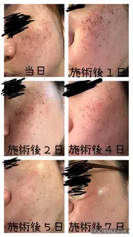 男女可能、顔のシミ取り5Dフォト初回5500円、ミニモ限定メニュー、ミニモ学割、メンズOK