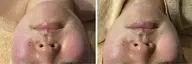 韓国から毛穴洗浄上陸!吸引せず毛穴角質徹底洗浄！感動の水光肌へ