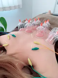 【☘️首肩こり集中ケア☘️】ボディ鍼灸×吸玉コース✨✨