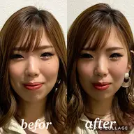 小顔ソムリエ®︎による小顔矯正+お顔の筋トレ美容鍼
