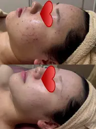 3連休限定✨肌管理プログラム‼✨人気のピーリング&美容液導入&マッサージ❤️美白/小顔/毛穴ケア🫧肌リセット+肌育